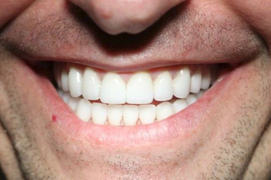 After photo, smile makeover case 1 at Smiley Cypress Dental Care