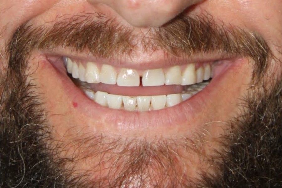 Before photo, smile makeover case 1 at Smiley Cypress Dental Care