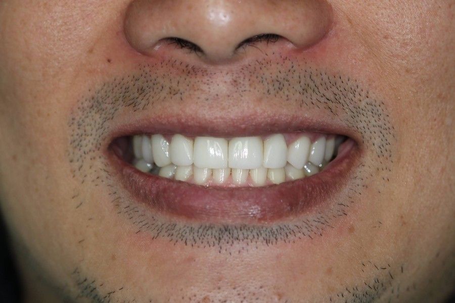 After photo, smile makeover case 2 at Smiley Cypress Dental Care