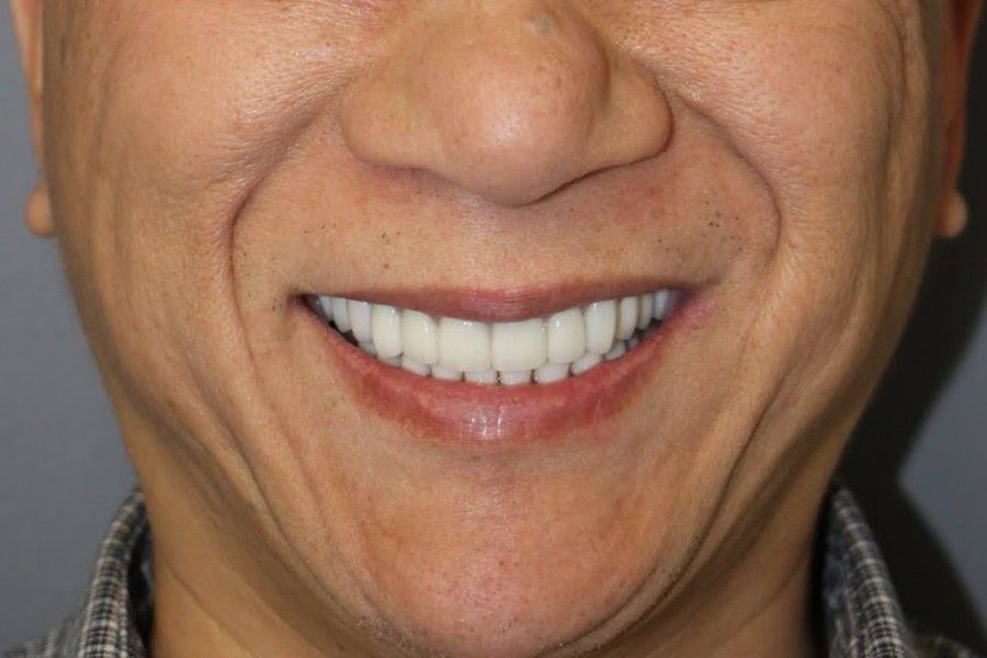 After photo, smile makeover case 6 at Smiley Cypress Dental Care