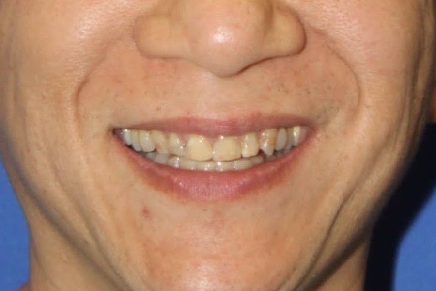 Before photo, smile makeover case 6 at Smiley Cypress Dental Care