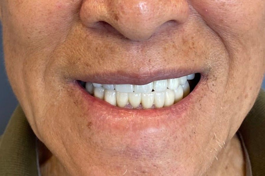 After photo, smile makeover case 7 at Smiley Cypress Dental Care