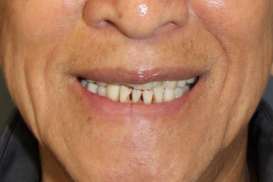 Before photo, smile makeover case 7 at Smiley Cypress Dental Care