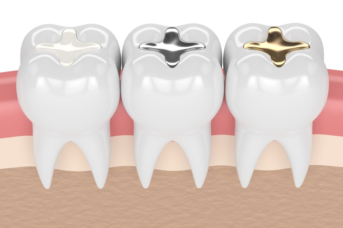 DentalRestorationMaterials