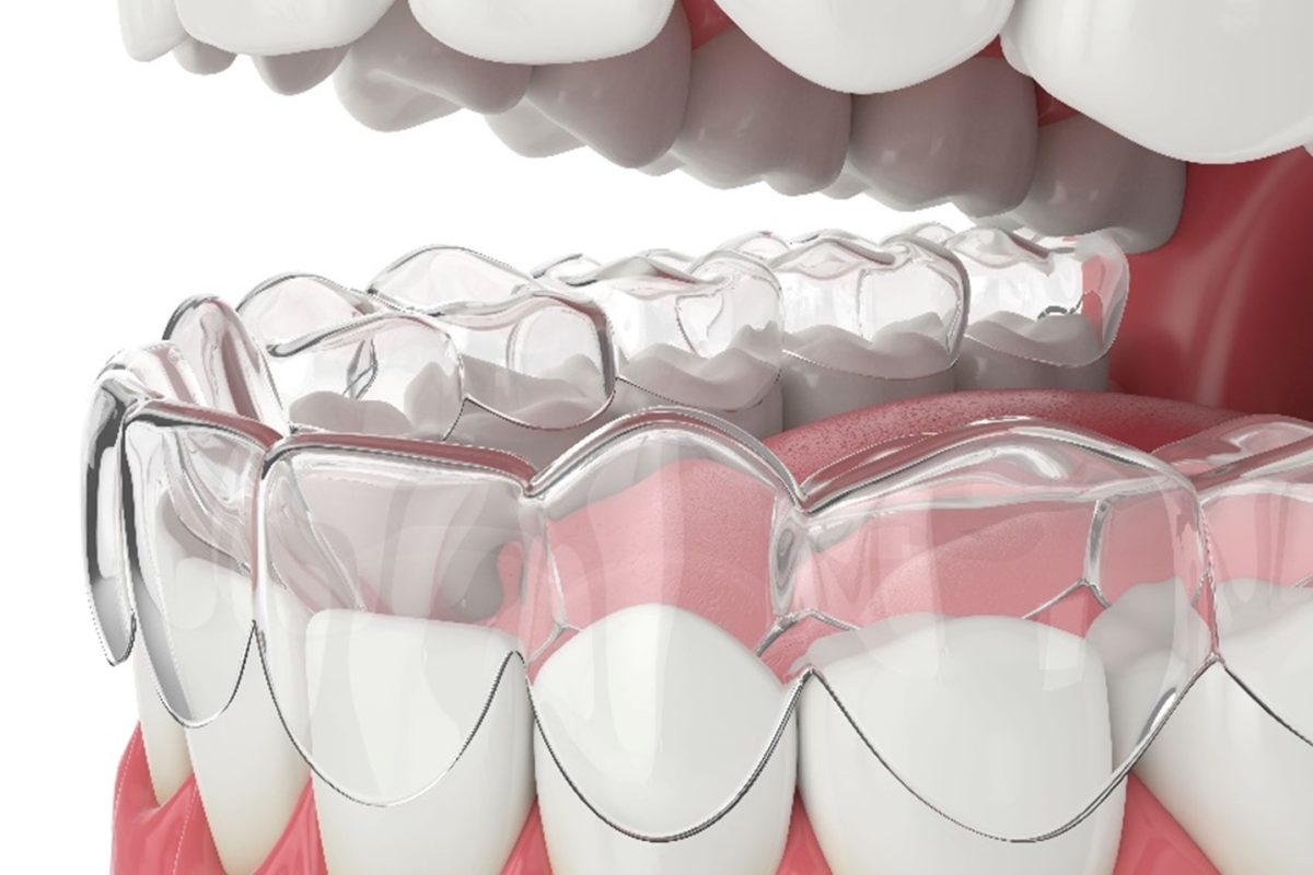 clear-aligner