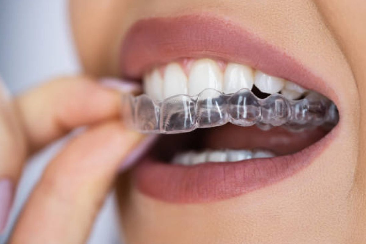 clear-aligners-2000x1200