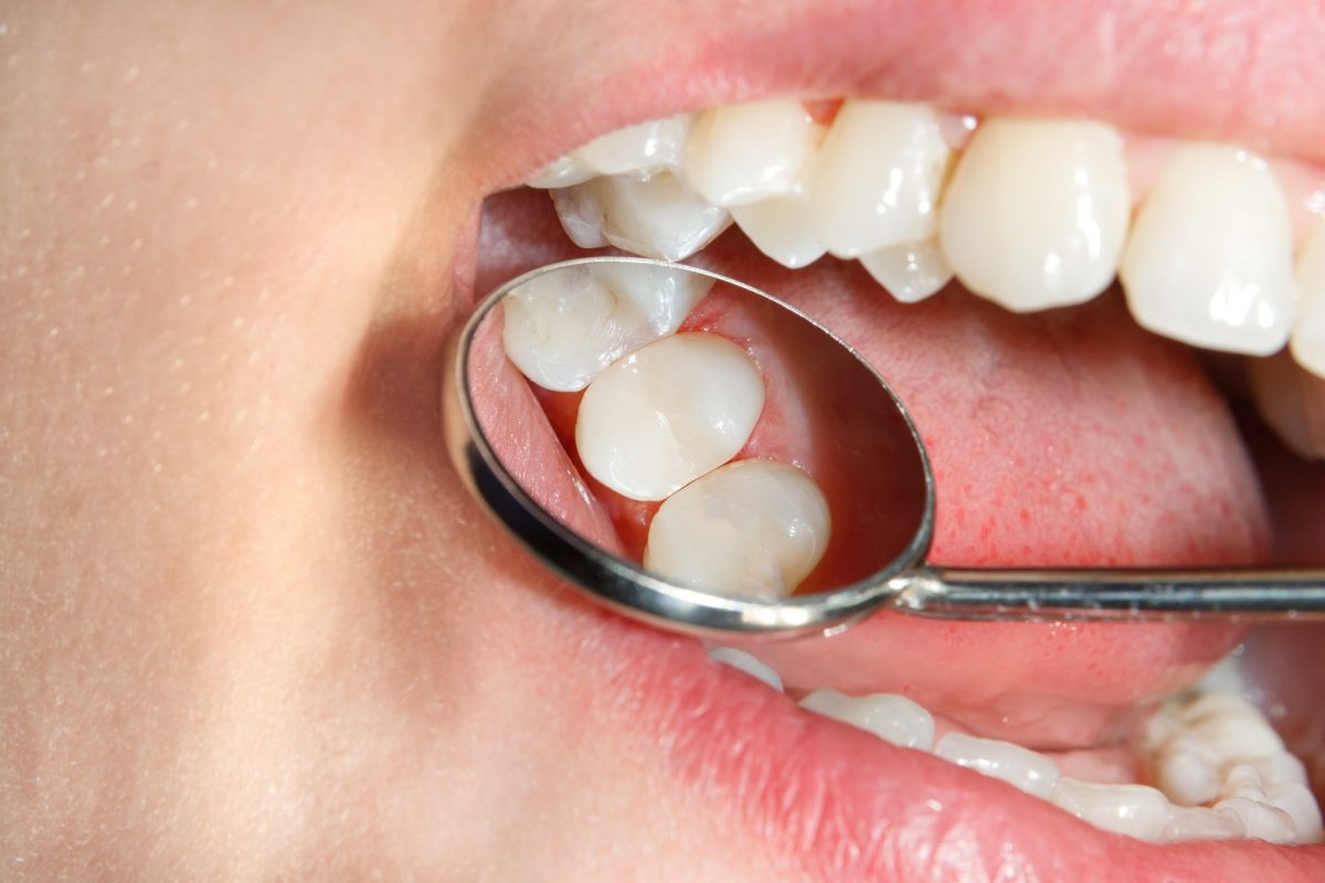fillings
