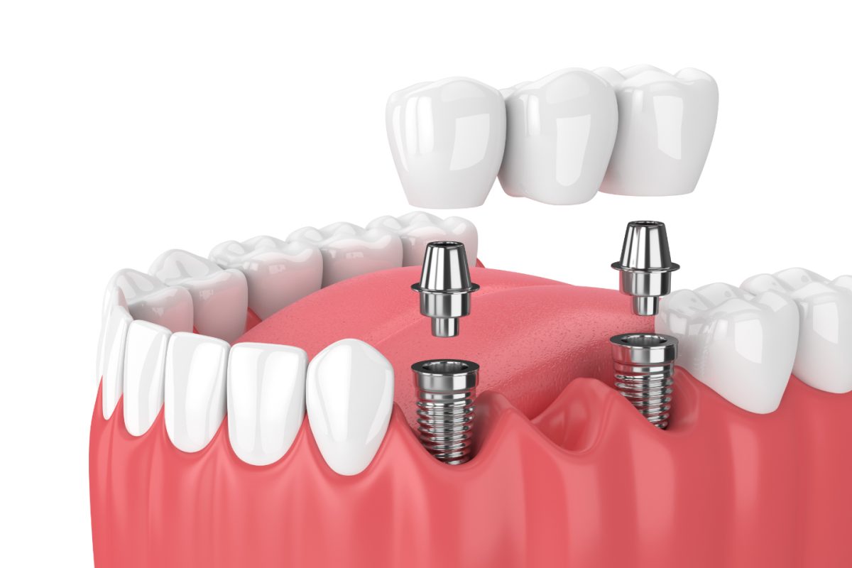 implantdisnedir